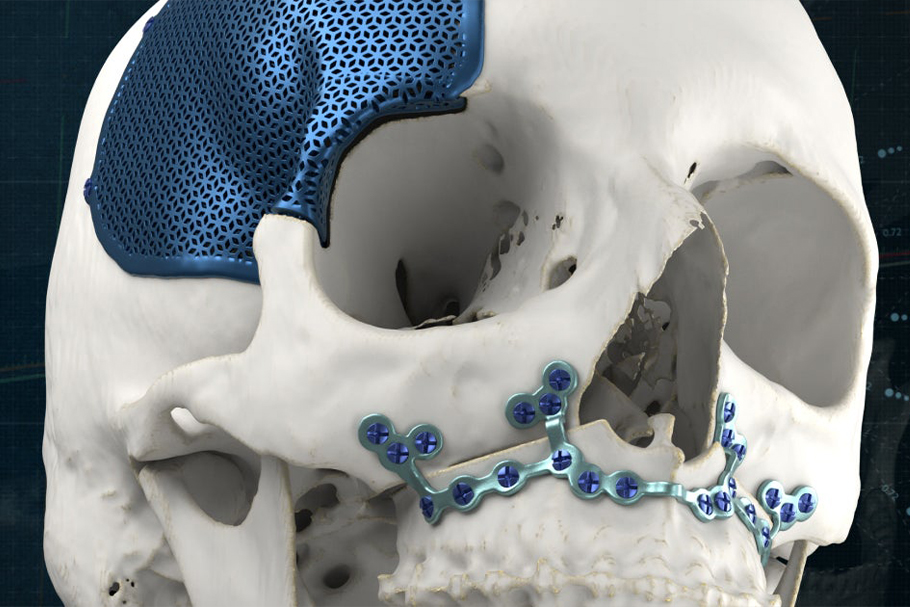 Cranioplasty