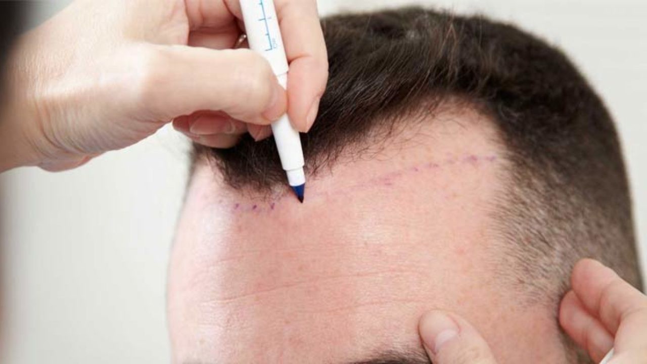 Hair Transplant
