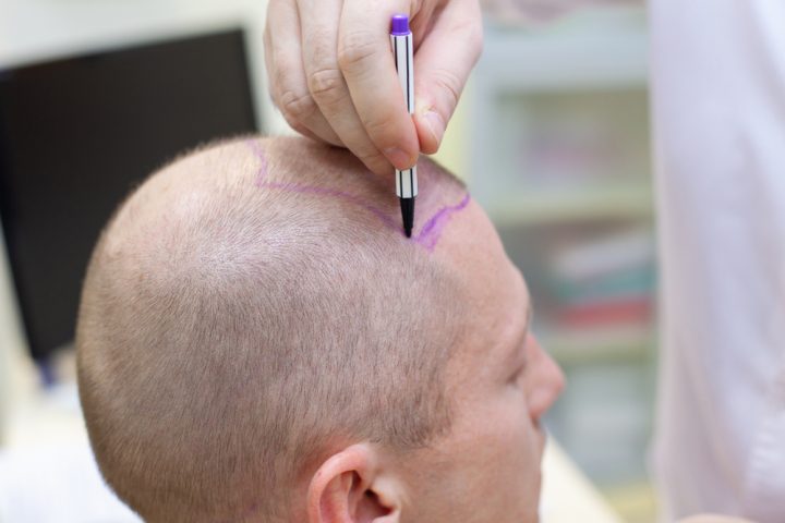 Hair Transplant