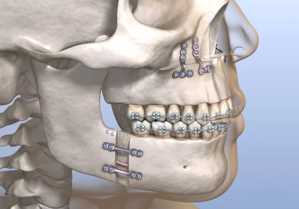 Osteotomy